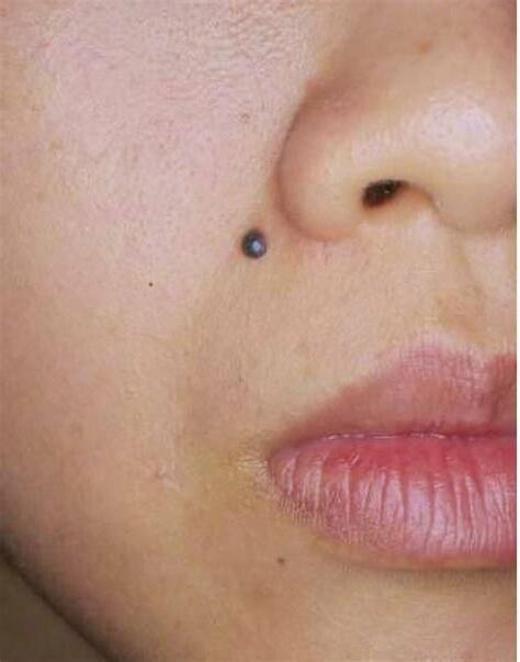 吉痣 惡痣